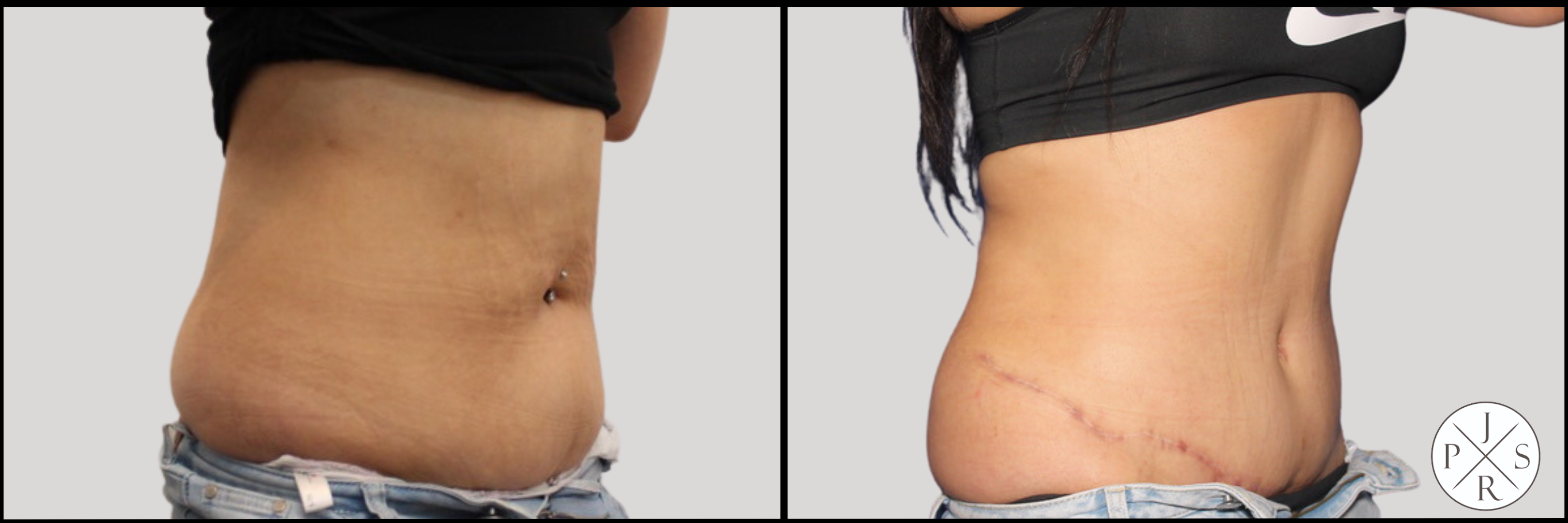 Abdominoplasty Before & After Image